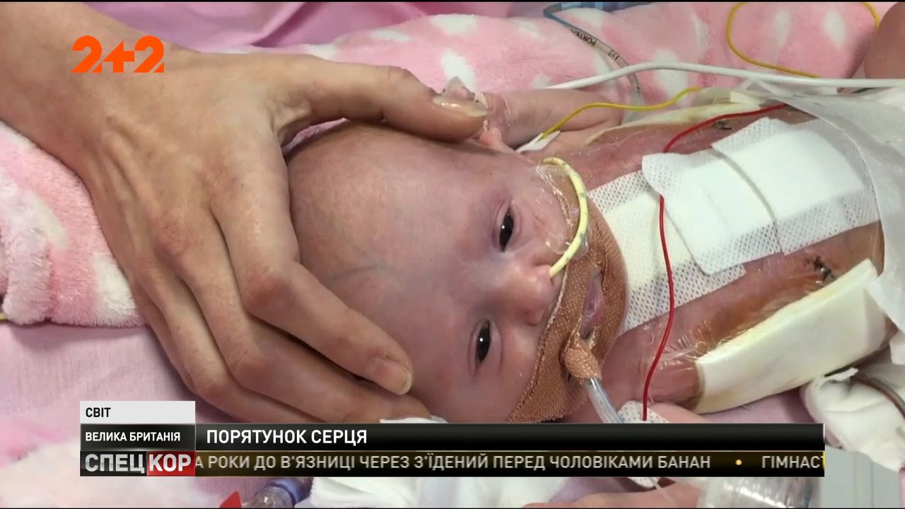 Британські лікарі врятували немовля, яке народилось із серцем назовні