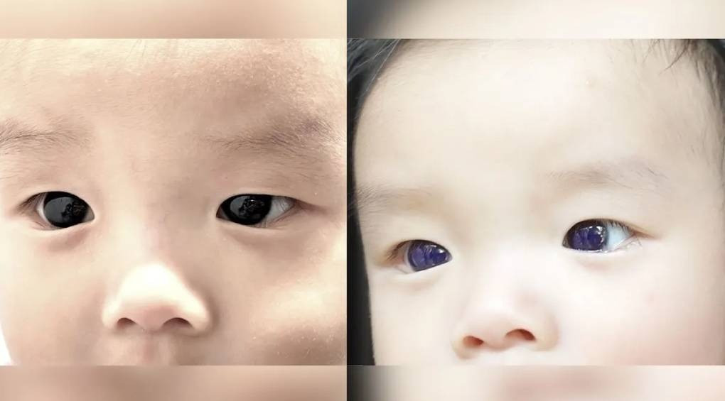 У 6-месячного мальчика после приема препарата для лечения COVID-19 изменился цвет глаз