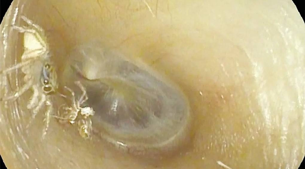 Чула аномальне биття, клацання та шурхіт: у вусі 64-річної жінки лікарі виявили павука, який скинув там екзоскелет