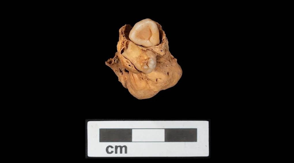 Археологи раскопали 3000-летнее захоронение женщины с опухолью яичников в которой выросли зубы