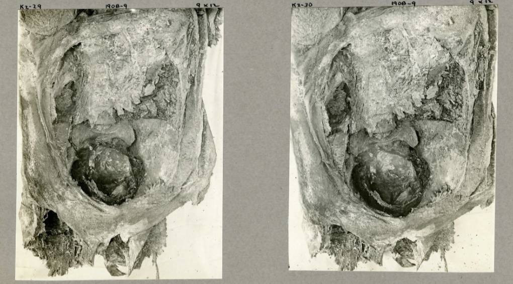 Жуткая находка: на рентгене египетской мумии девочки-подростка ученые нашли в ее груди плод ребенка
