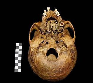 Первый в Европе: археологи обнаружили уникальный протез в черепе человека 18-го века