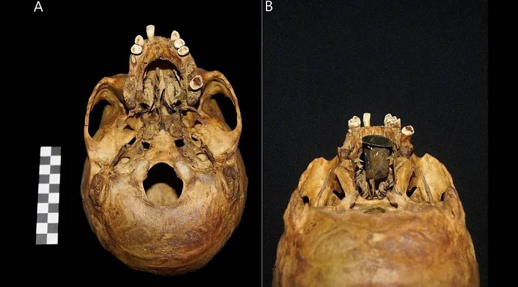 Перший в Європі: археологи знайшли унікальний протез у черепі людини 18-го століття